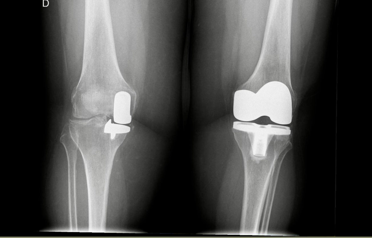 Radiografía de Prótesis de Rodilla